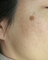 老人性色素斑(ろうじんせいしきそはん)