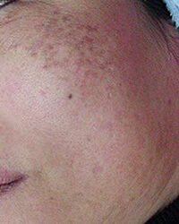 肝斑(かんぱん)