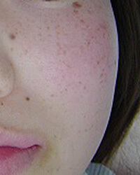 雀卵斑(じゃくらんはん)