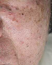 脂漏性角化症(しろうせいかくかしょう)