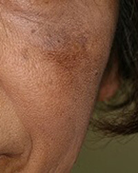 ADM(後天性メラノサイトーシス)