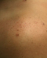 花弁状色素斑(かべんじょうしきそはん)