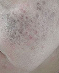 太田母斑(おおたぼはん)